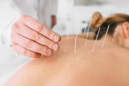 45-Min Acupuncture, Acupressure & Tui Na Massage - Newcastle