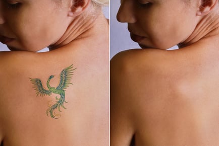 Six Tattoo Removal Sessions - Small, Medium, Large Areas