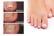 Ingrown-Toenail-Correction-Patch-Stickers-5