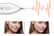 Portable-Skin-Tag-Remover-Pen-3