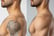 Men's Laser Tattoo Removal - Small, Medium or Large Area - 6 Locations!