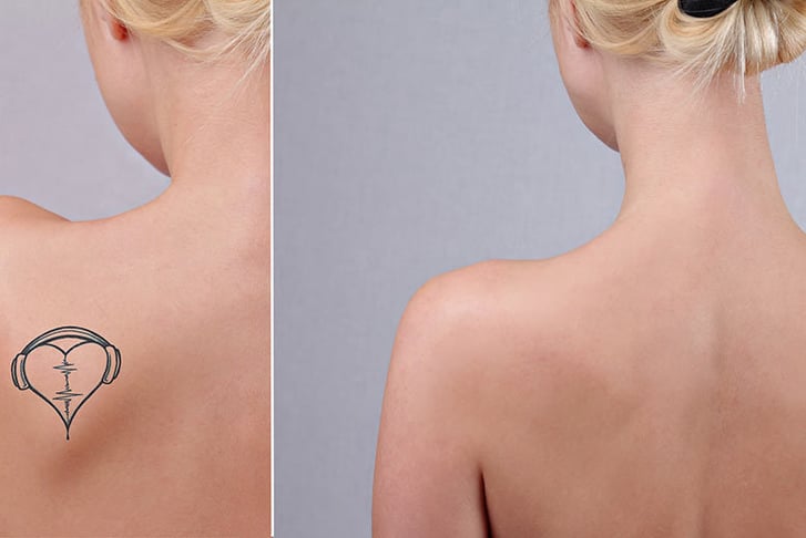Tattoo Laser Removal Shangi-La Beauty Clinic Cork 