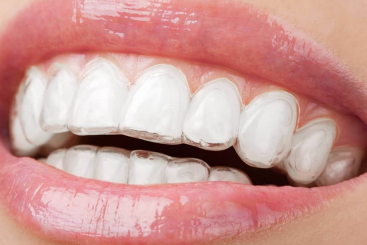 Clear Set of Teeth Aligners, 3D Scan & Treatment Plan - Paddington