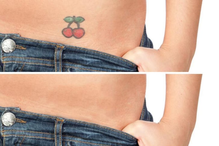 tattoo-removal-new-one