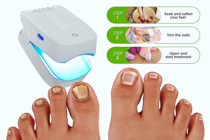 Fungal-Nail-Laser-Device-1