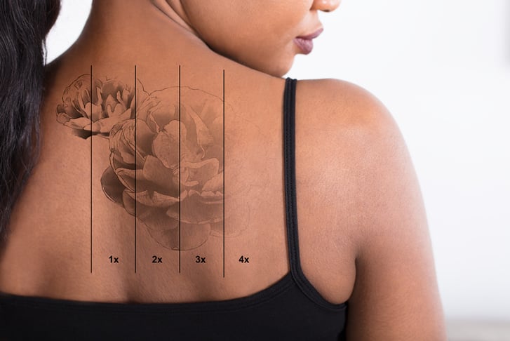 Laser Tattoo Removal - Small-Large Area - 6 Locations!