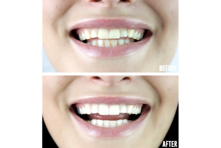 Charcoal-extreme-teeth-whitening-duo-3