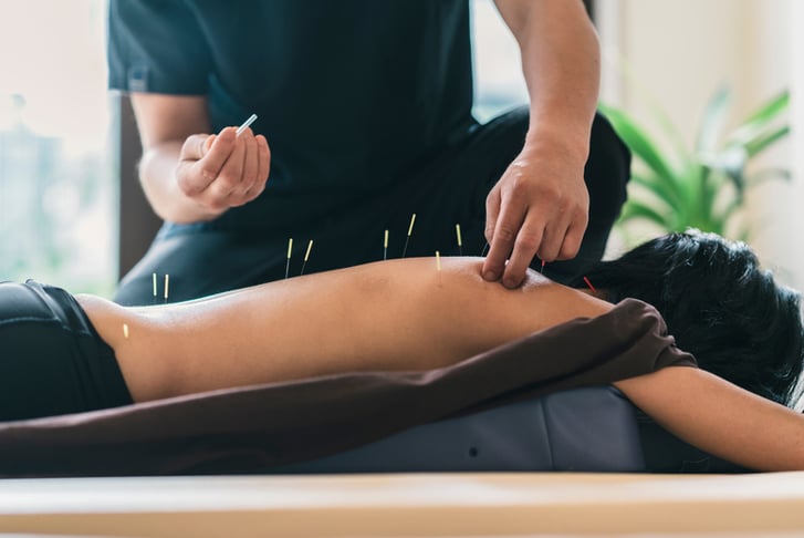 Acupuncture or Cupping Consultation and 2 Treatments in London