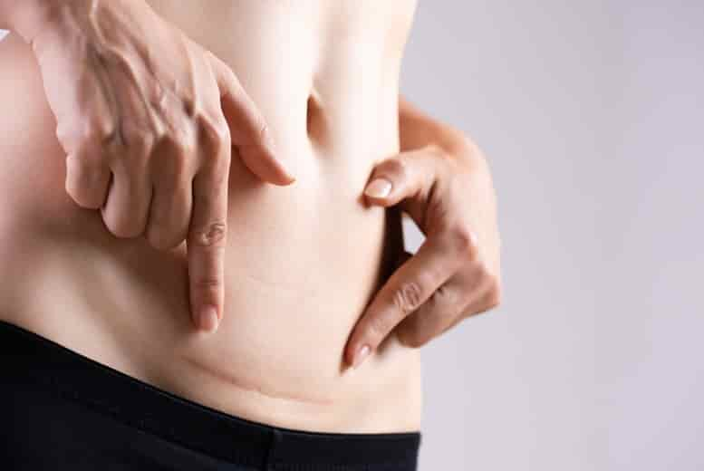 Tummy Tightening Treatment – Edgware - London - Wowcher