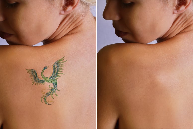 Tattoo Removal, Consultation and Patch Test